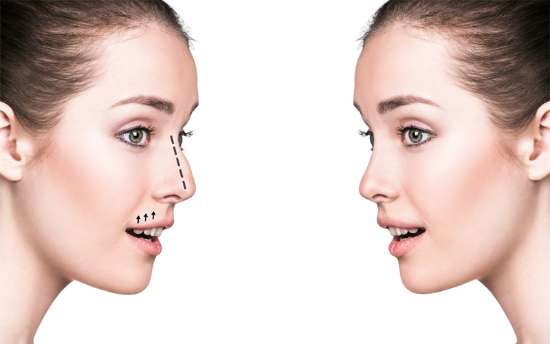 septoplastia