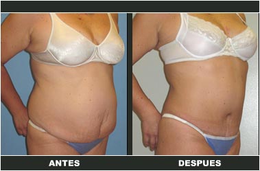 a-clasica_01 Abdominoplastia antes y después