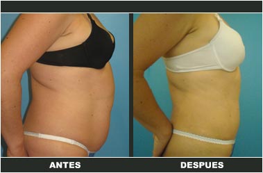 a-clasica_03 Abdominoplastia antes y después
