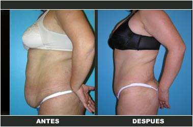 a-clasica_07 Abdominoplastia antes y después