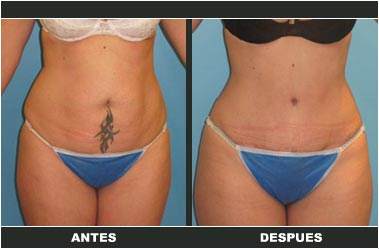 a-clasica_08 Abdominoplastia antes y después
