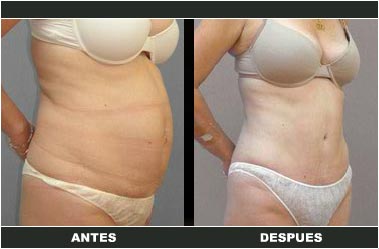a-clasica_26 Abdominoplastia