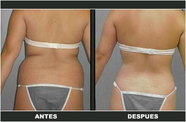 a-clasica_30 Abdominoplastia antes y después