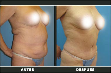 a-clasica_36 Abdominoplastia antes y después