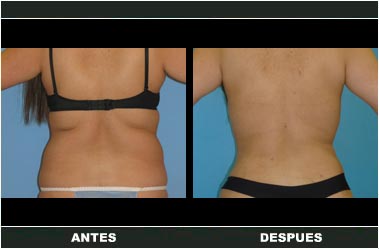 a-clasica_38 Abdominoplastia antes y después