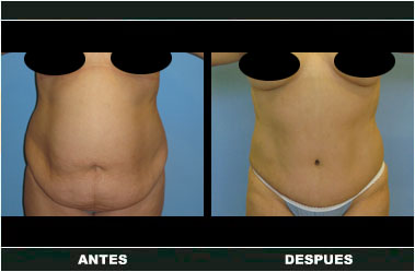 a-clasica_42 Abdominoplastia antes y después