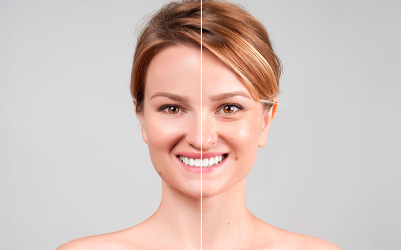 Botox